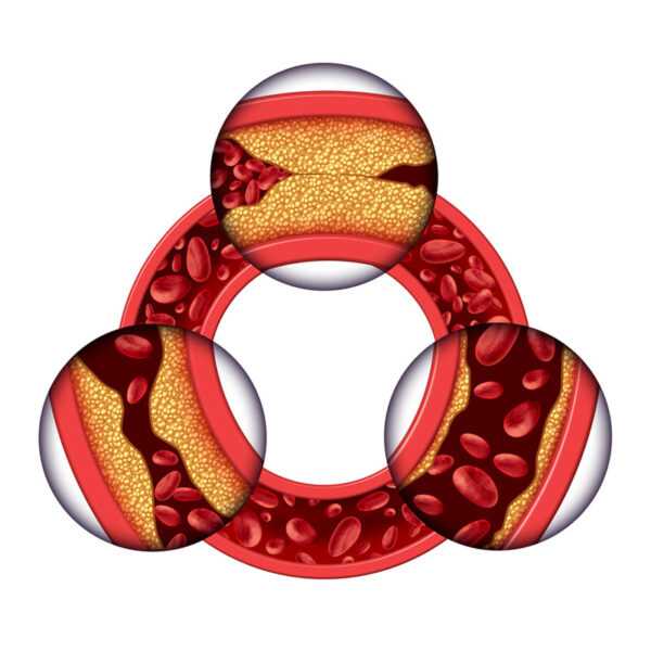 A diagram showing the structure of a blood vessel and the effects of high cholesterol.